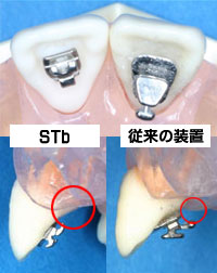 ＳＴｂ装置と従来の装置の比較