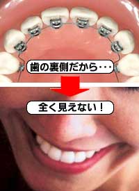 歯の裏側だから→全く見えない！