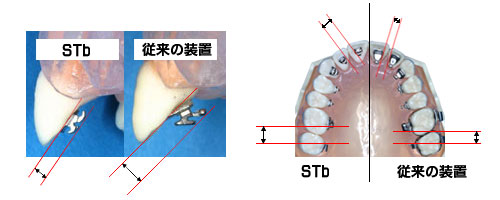 従来装置の比較（薄さとブラケット間隔）